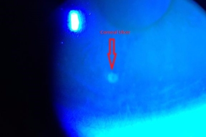 Contact_Lens_Related_Small_Corneal_Ulcer_with_Sodium_Fluorescein_Staining_1